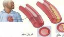 ماهي اعراض تصلب الشرايين