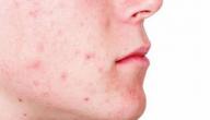 حل مشكلة حب الشباب للبشرة الدهنية