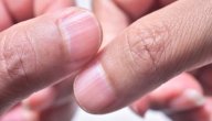 ما هو سبب ظهور خطوط على الأظافر؟