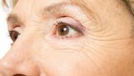 أسباب ظهور خطوط تحت العين