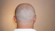 أضرار إزالة الشعر بالشفرة