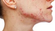 أسباب ظهور حبوب تحت الجلد في الوجه