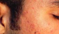 التخلص من ندبات حب الشباب