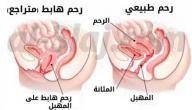 أضرار هبوط الرحم