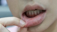 علاج الحمى في الفم