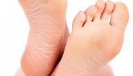 طريقة علاج تشقق القدمين