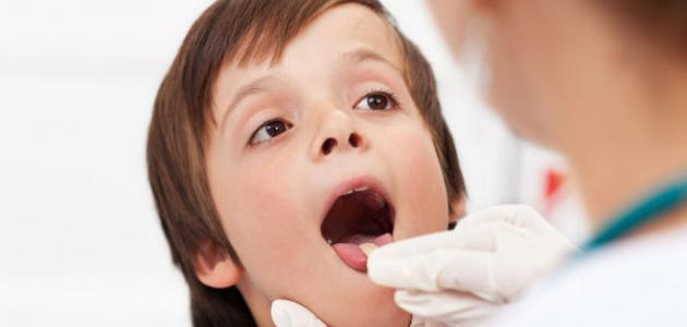 علاج بحة الصوت بالزنجبيل