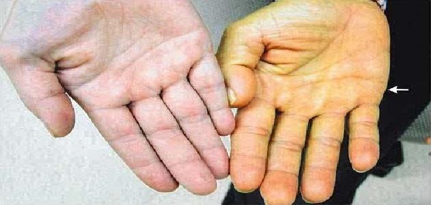 اسباب اصفرار البشرة
