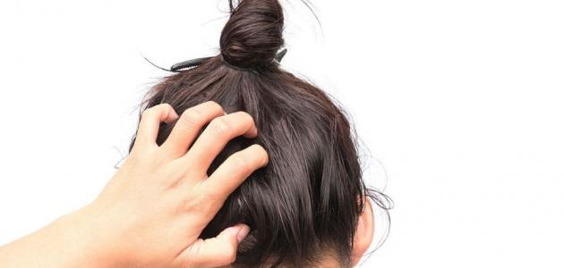 فطريات الراس عند الاطفال