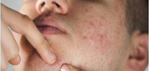 خلطة لازالة اثار الحبوب في اسبوع