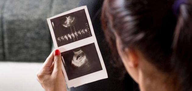 علامات الحمل بكيس بدون جنين