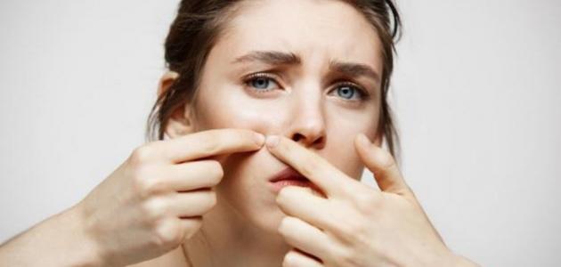 علاج حب الشباب والحفر بالأعشاب