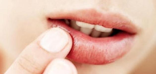 علاج حساسية الشفايف