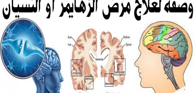 علاج مرض زهايمر