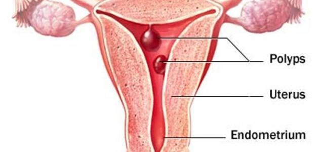 علاج نزيف الرحم المستمر