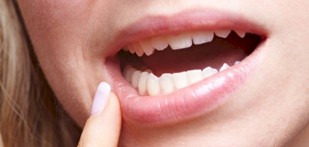 كم عدد أضراس العقل؟