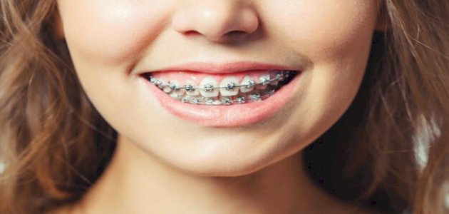 اضرار تقويم الاسنان على المدى البعيد