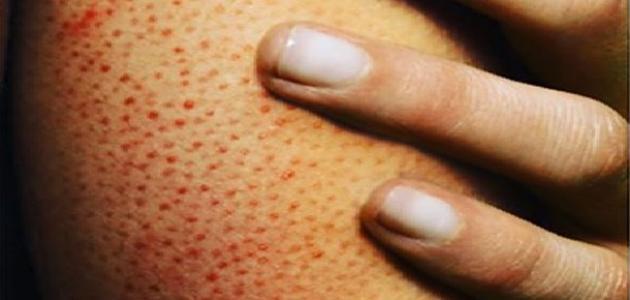 أسباب ظهور بقع دم تحت الجلد
