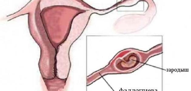 أعراض كيس دم على المبيض