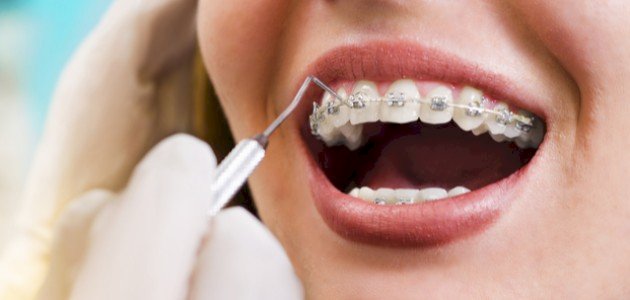 تقويم الأسنان: ما هي فوائده وفي أي عمر يمكنكِ تركيبه؟