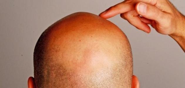 أعراض لخبطة الهرمونات بعد حبوب منع الحمل