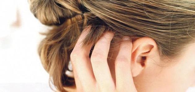 علاج الحكة في فروة الرأس