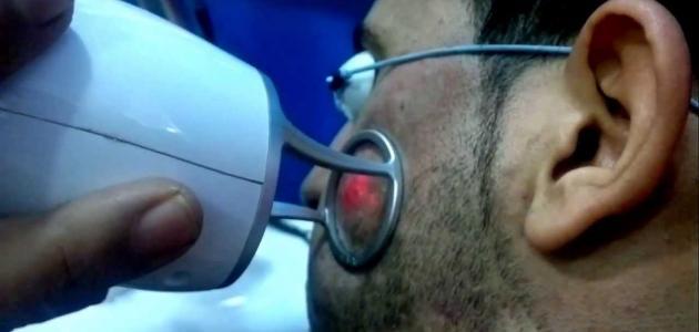 أضرار علاج حب الشباب بالليزر