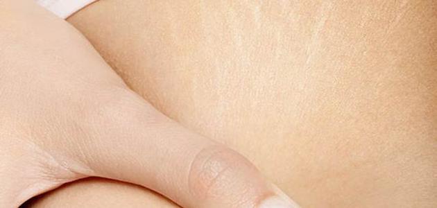 التخلص من الترهلات والخطوط البيضاء