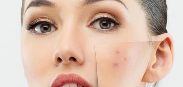 ماسك للتخلص من اثار الحبوب