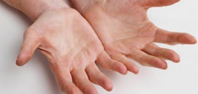علاج تعرق القدمين