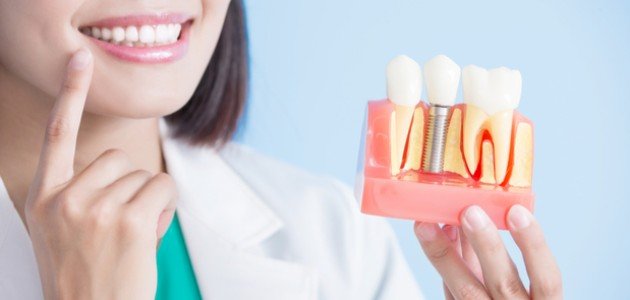 كيف تتم زراعة الأسنان؟