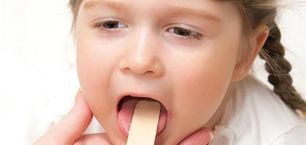 أسباب التهاب الحلق عند الأطفال